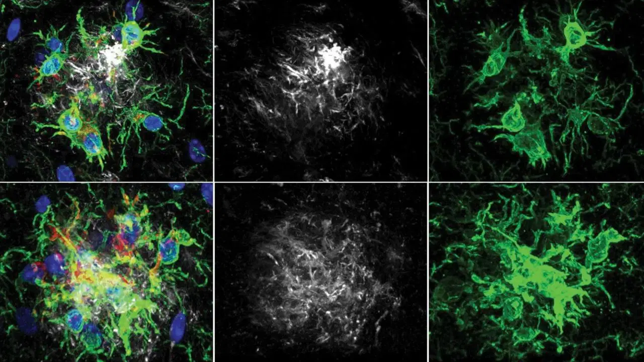 Alzheimer tedavisinde yeni ufuk: Beynin ‘temizlik ekibi’ yeniden programlandı