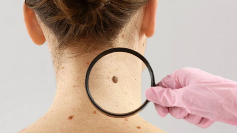 dermatoloji-uzmani-acikladi-benlerdeki-degisiklikleri-hafife-almayin-RKeriGEu.jpg