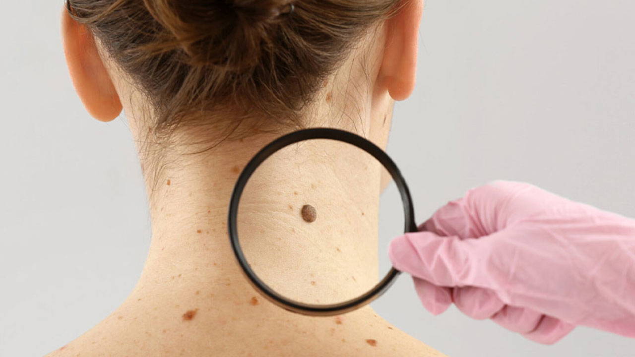 dermatoloji-uzmani-acikladi-benlerdeki-degisiklikleri-hafife-almayin-RKeriGEu.jpg