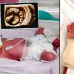 15 milyonda bir gerceklesiyor tek yumurta dorduzleri kayitlara gecen ilk vaka w3iygrBt.jpg