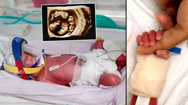 15 milyonda bir gerceklesiyor tek yumurta dorduzleri kayitlara gecen ilk vaka w3iygrBt.jpg