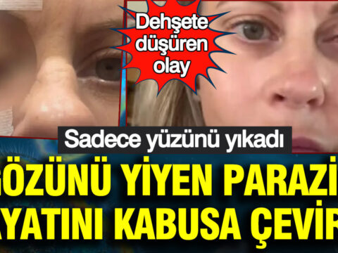 Dehsete dusuren olay sadece yuzunu yikadi gozunu yiyen parazit hayatini kabusa cevirdi tI4VRzgk.jpg