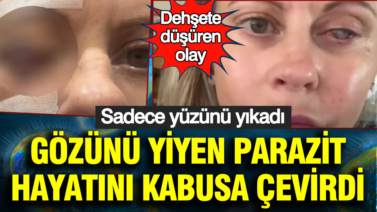 Dehsete dusuren olay sadece yuzunu yikadi gozunu yiyen parazit hayatini kabusa cevirdi tI4VRzgk.jpg