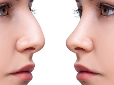 Uzmandan burun ameliyati sonrasi yaz uyarisi ilk 6 ay gunesten korunmak onemli eeG8pzTP.webp
