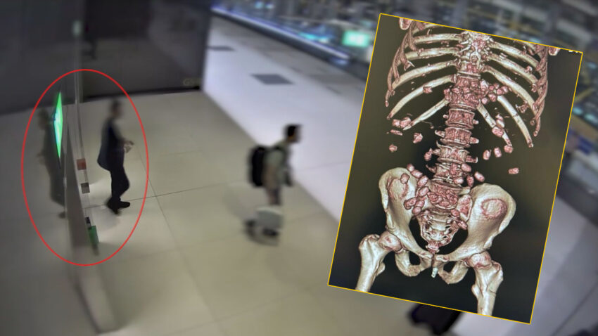 Yurumekte zorlaninca kendini ele verdi midesinden kapsul kapsul uyusturucu cikti knpJnqID.jpg