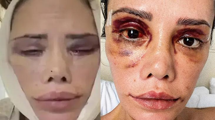 Yuz nakli olan survivor didem ceran son halini paylasti hepinizden cok ozur diliyorum evhTQ4Ra.jpg