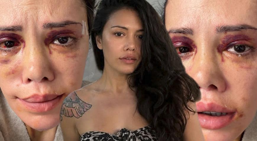 Yüz naklinin ardından revizyon ameliyatı olmuştu! Didem Ceran gözyaşlarına boğuldu